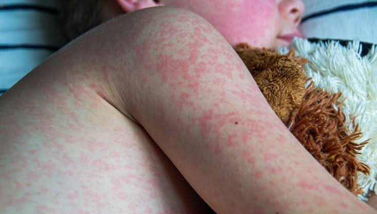 Confirman alerta sanitaria por casos importados de sarampión
