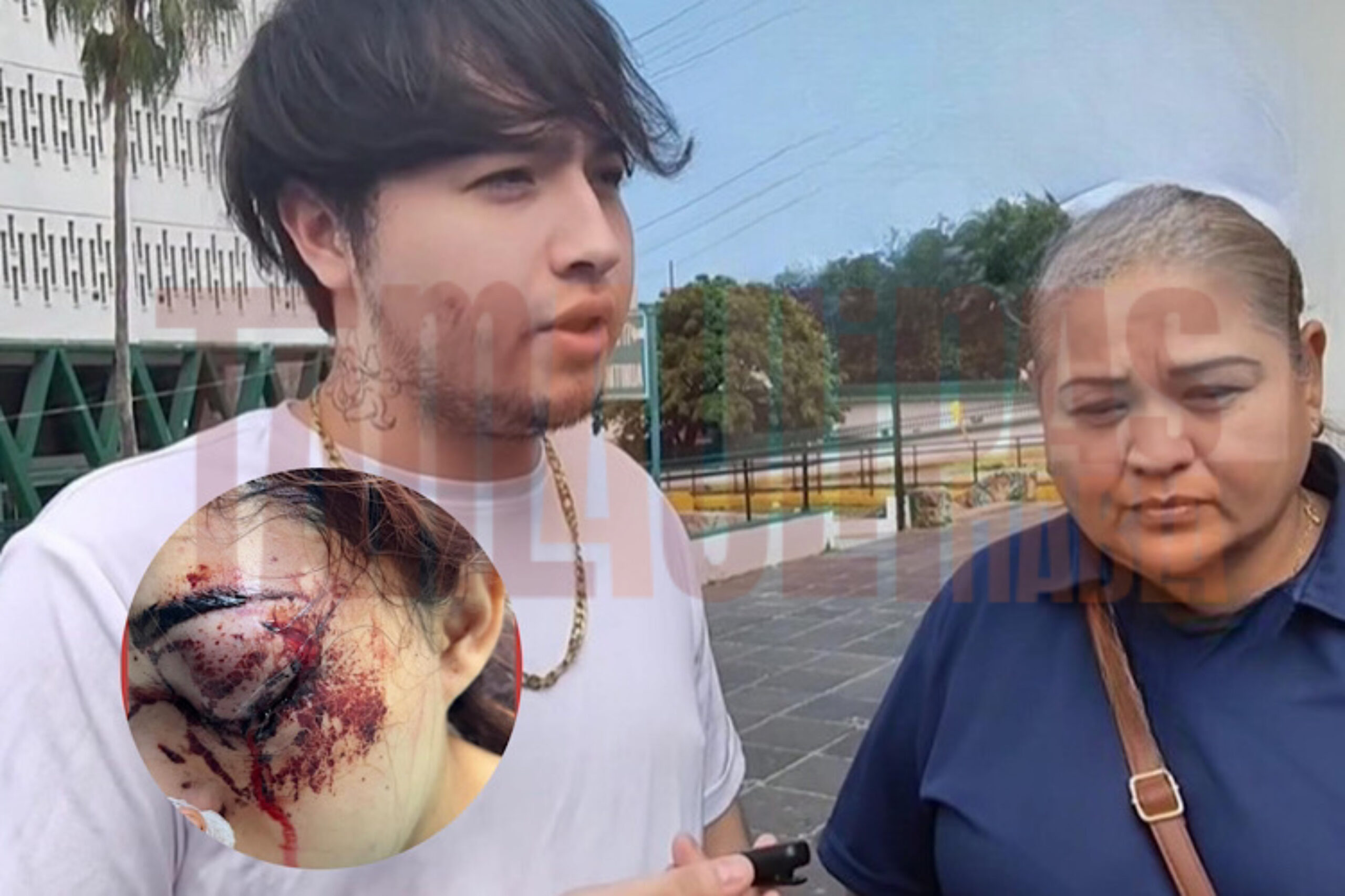‘El ojo podría quedarle de fuera’, Melanie es sometida a cirugía